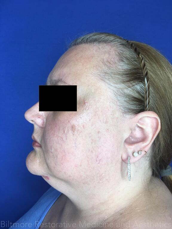 Double Chin Treatments Before & After Image