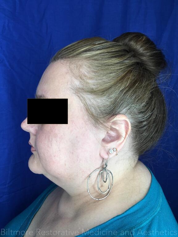 Double Chin Treatments Before & After Image