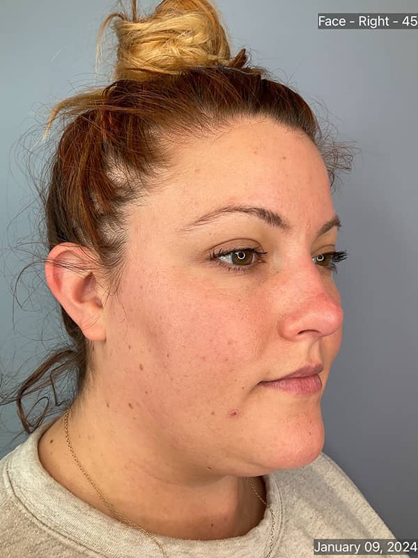 Double Chin Treatments Before & After Image