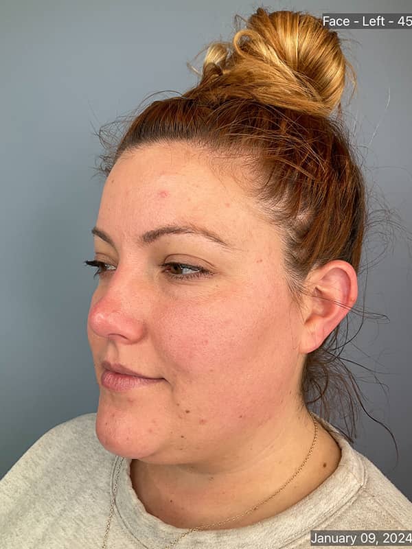 Double Chin Treatments Before & After Image