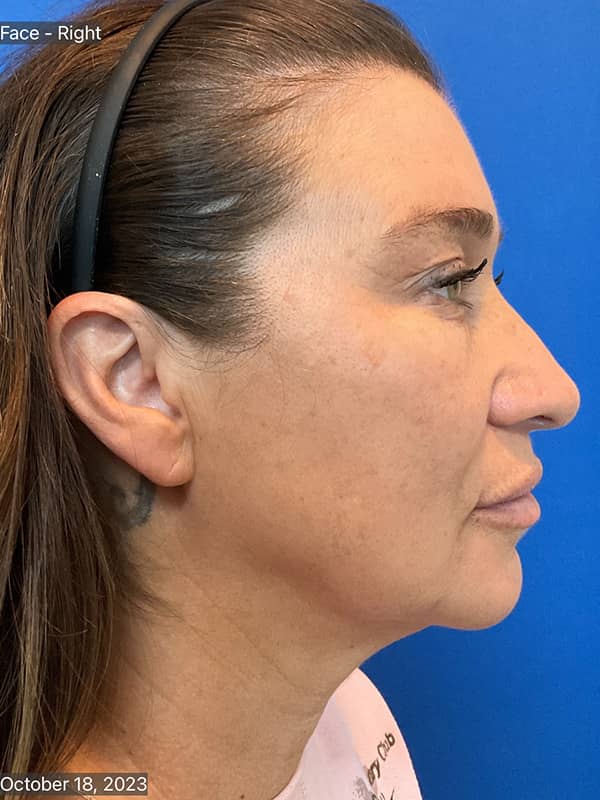 Double Chin Treatments Before & After Image