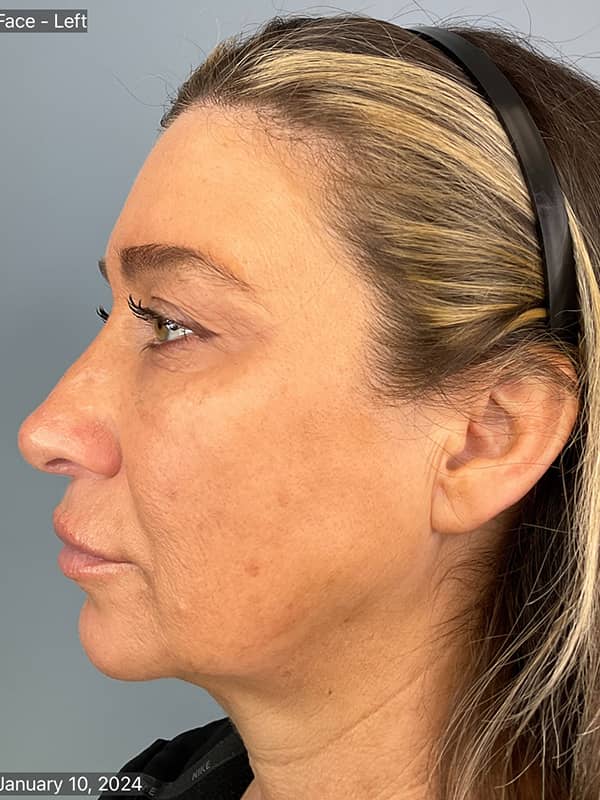 Double Chin Treatments Before & After Image