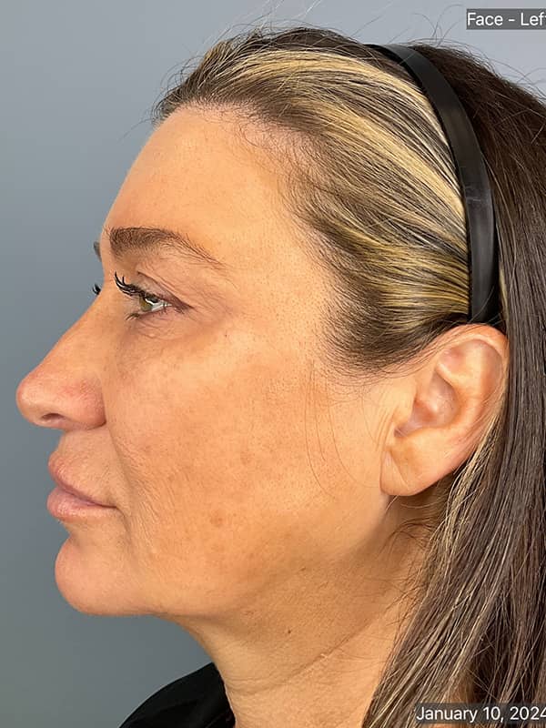 Double Chin Treatments Before & After Image