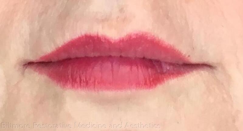 Lip Filler Before & After Image