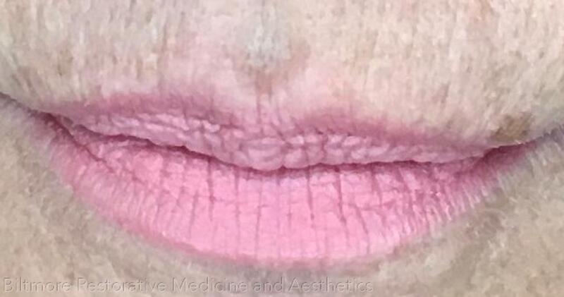 Lip Filler Before & After Image