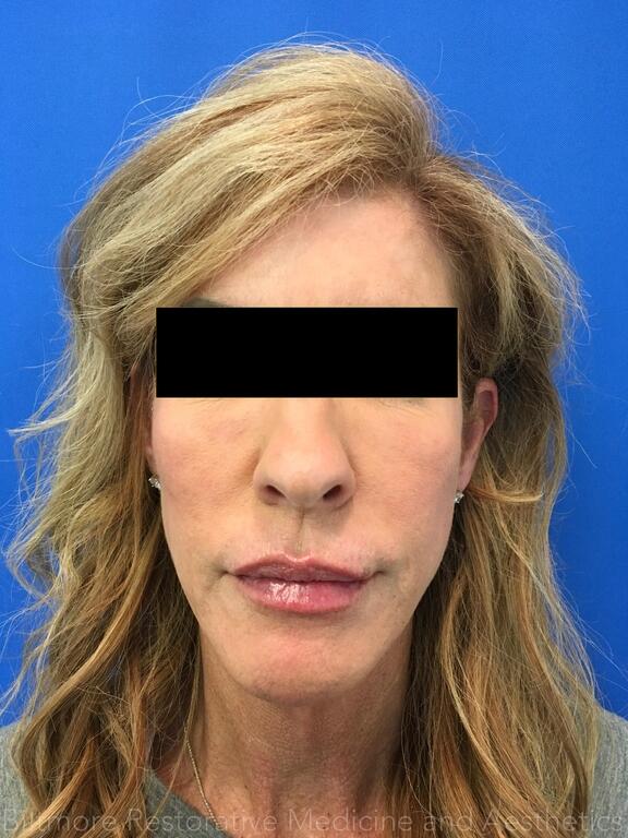 Lip Filler Before & After Image