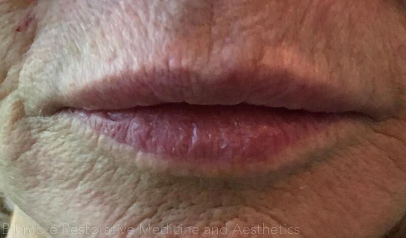 Lip Filler Before & After Image