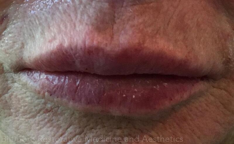 Lip Filler Before & After Image