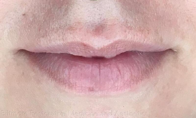 Lip Filler Before & After Image