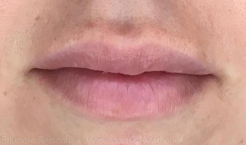 Lip Filler Before & After Image