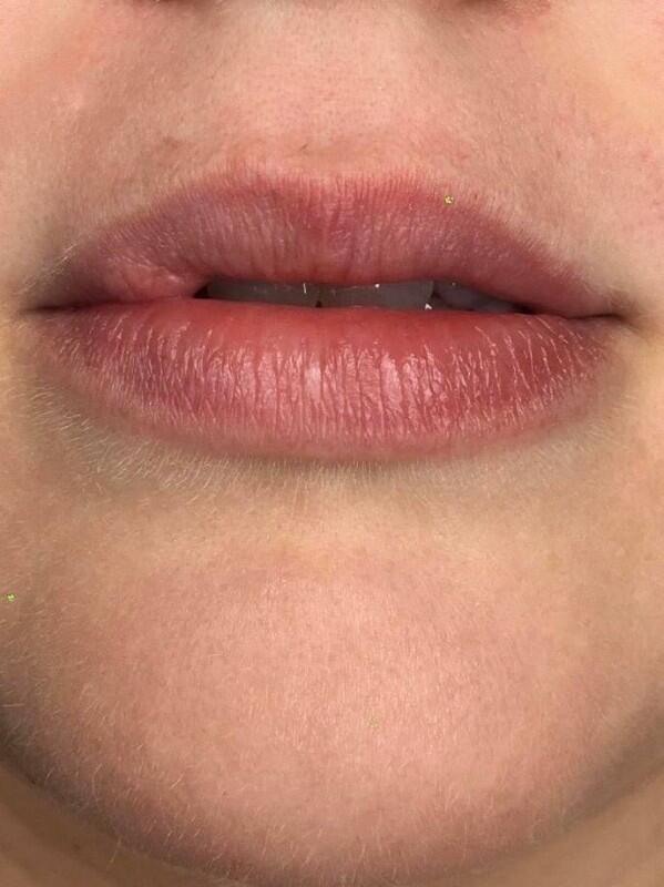 Lip Filler Before & After Image