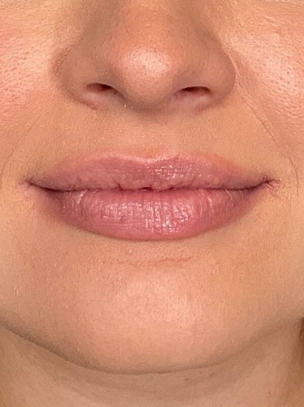 Lip Filler Before & After Image