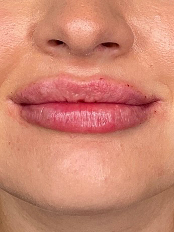 Lip Filler Before & After Image