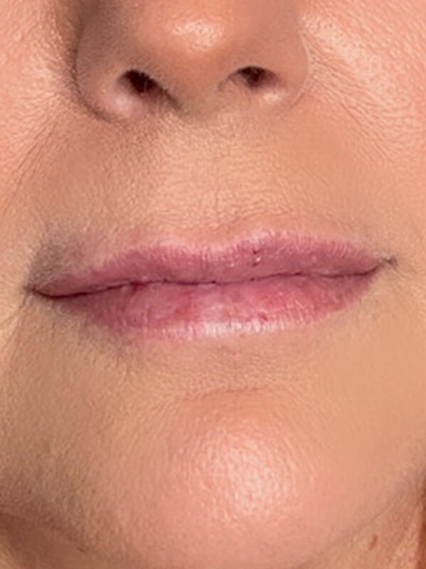 Lip Filler Before & After Image