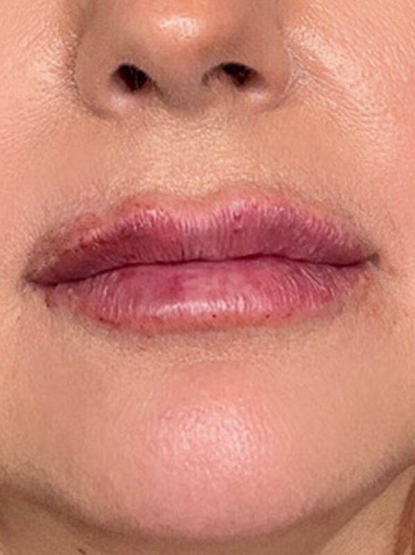 Lip Filler Before & After Image