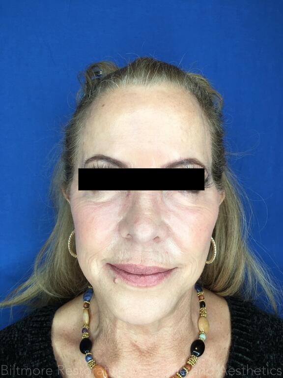 Sculptra Before & After Image