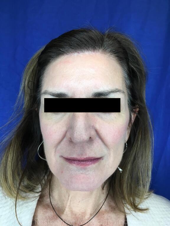 Sculptra Before & After Image