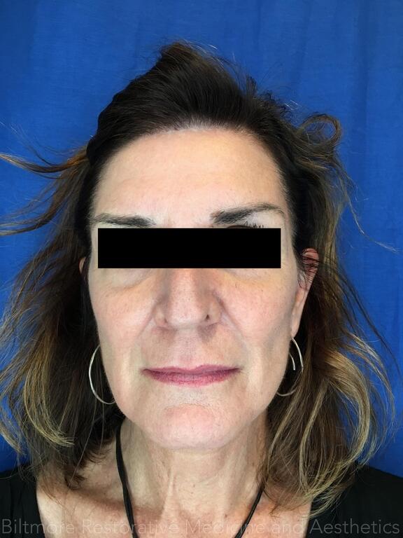 Sculptra Before & After Image