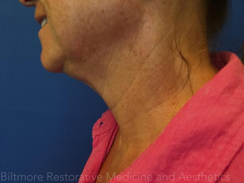 Sculptra Before & After Image