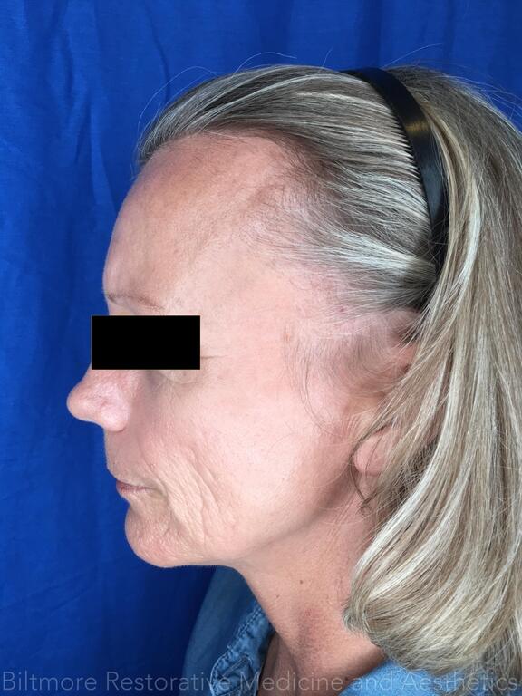 Sculptra Before & After Image