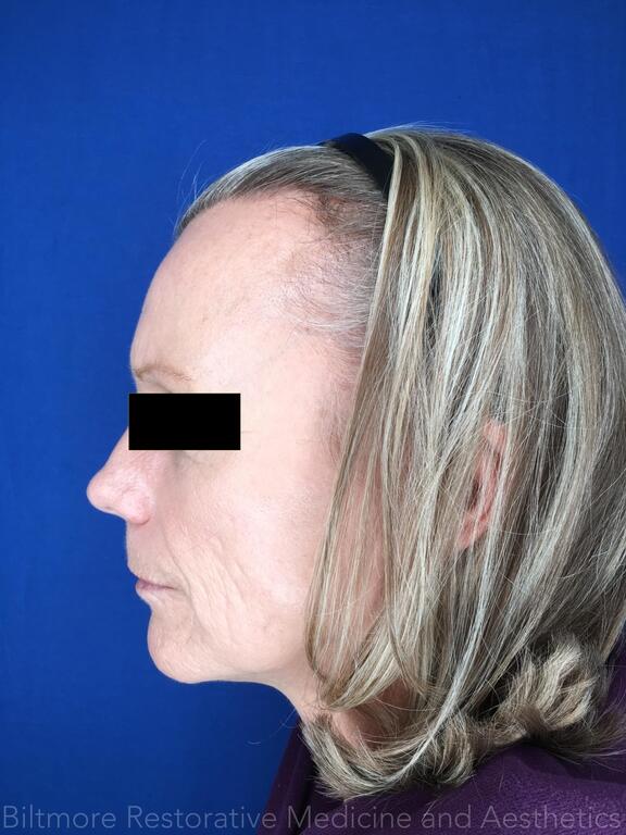 Sculptra Before & After Image