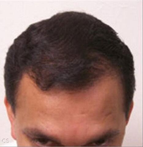 Hair PRP Growth Factors & Products Before & After Image