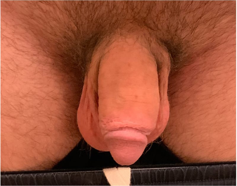 Penile Enhancement Before & After Image