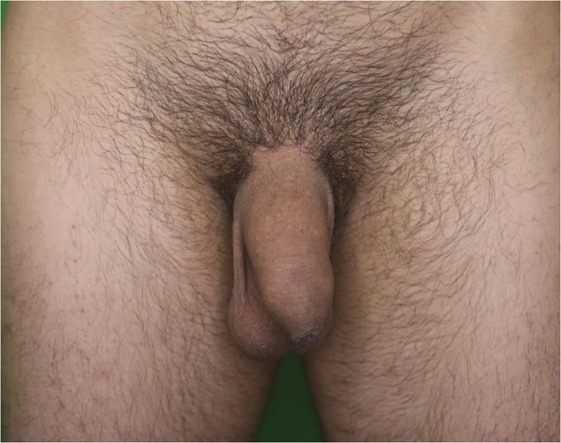 Penile Enhancement Before & After Image