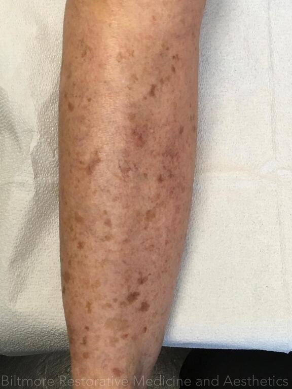 Brown Spot Reduction Before & After Image