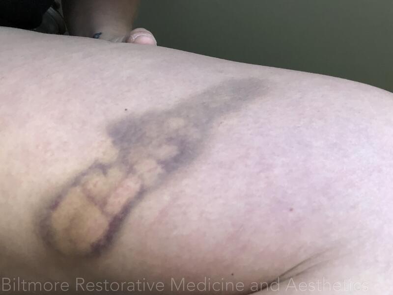 Bruises Treated Before & After Image