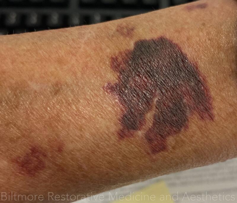 Bruises Treated Before & After Image