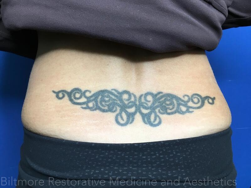 Tattoo Removal Before & After Image