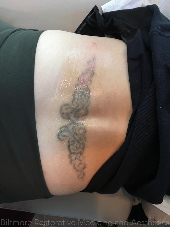 Tattoo Removal Before & After Image